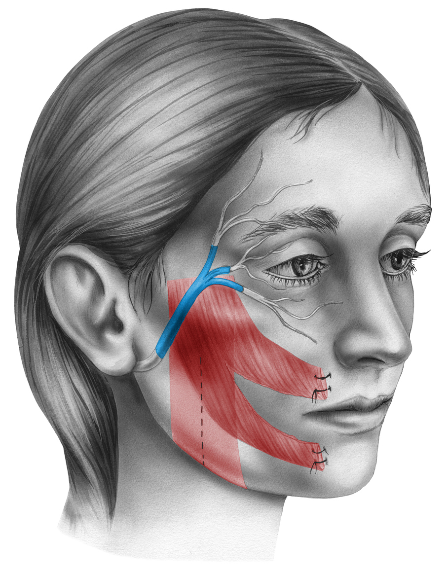 Bell’s Palsy Expert